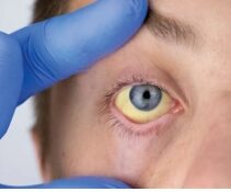 You are currently viewing HEALTH: LIVING WITH ANAEMIA.